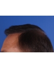 After Hair Transplant&nbsp;Front